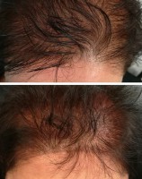 /album/fotogalerie/pm-aplikace-vlasu-mikropigmentaci-jpg4-jpg/